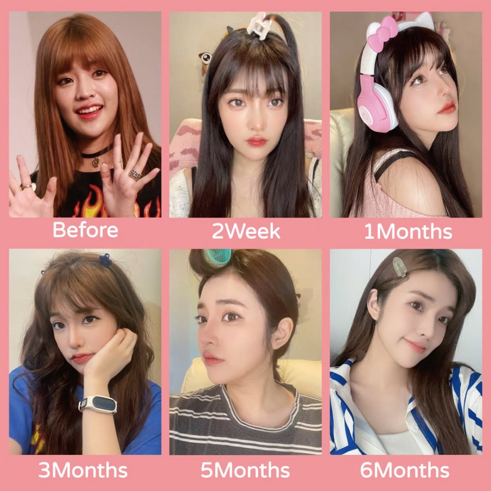 玻尿酸隆鼻植入劑殘留物清除,鼻重修恢復期,博恩妍